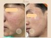Điều Trị Mụn Uy Tín  Tại Gò Vấp
