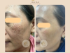 Khám phá Bí quyết Điều Trị Nám hiệu quả tại Alma Skin 