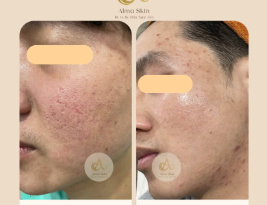 Điều Trị Mụn Uy Tín  Tại Gò Vấp