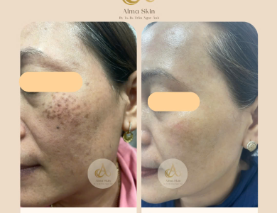 Khám phá Bí quyết Điều Trị Nám hiệu quả tại Alma Skin 