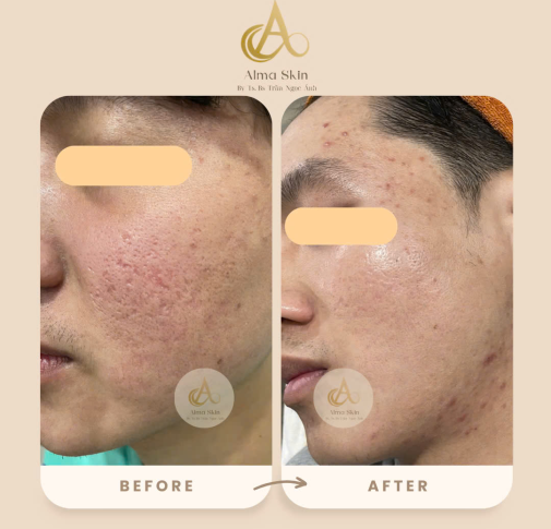 Điều Trị Mụn Uy Tín  Tại Gò Vấp