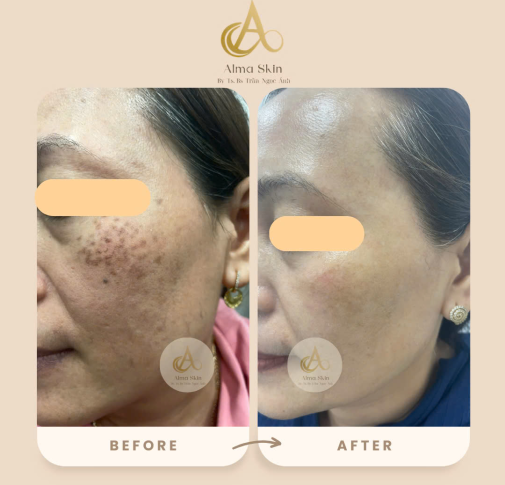 Khám phá Bí quyết Điều Trị Nám hiệu quả tại Alma Skin 